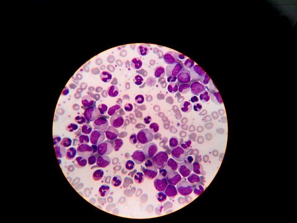 Ripani Musyaffa Ahdanlab Blog Pulas Tanding Wright Giemsa