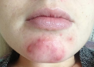 what foods cause acne