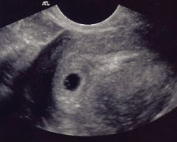 5 haftalık gebelik görüntüsü