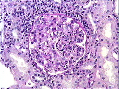 Glomerulonefrite acuta post- streptococcica