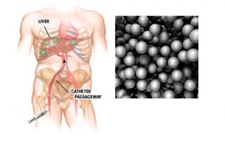 Phương pháp SIR-Spheres microspheres trong điều trị ung thư gan