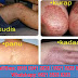 Nama Obat eksim di apotik thumbnail