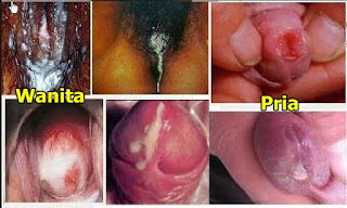 Tempat Jual Obat Kencing Nanah Di Pekanbaru