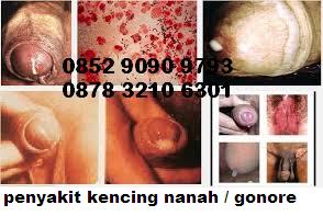 Cara Pengobatan Gonorrhea (Kelamin Keluar Nanah Belum Sembuh2) Cara Pengobatan Gonorrhea (Kelamin Keluar Nanah Belum Sembuh2)