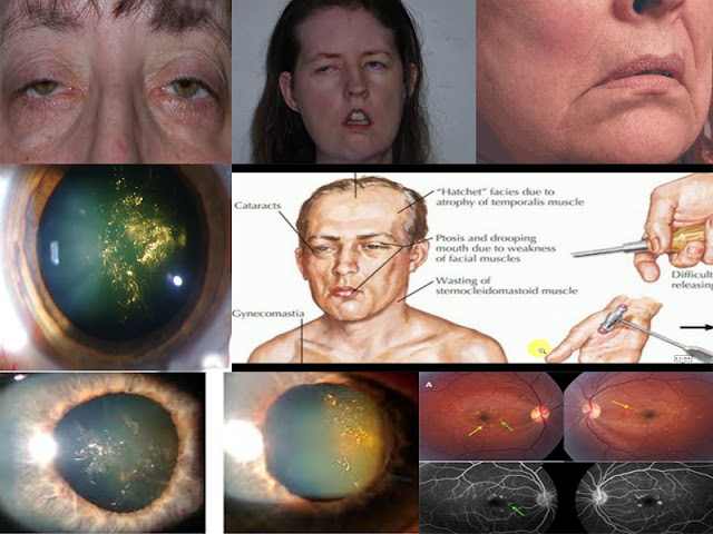 Myotonic Dystrophy: Systemic and Ocular manifestations, Investigation