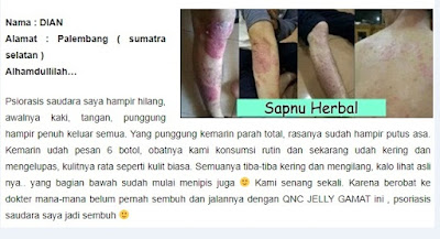 Cara Menyembuhkan Gabak Pada Orang Dewasa Cara Menyembuhkan Gabak Pada Orang Dewasa