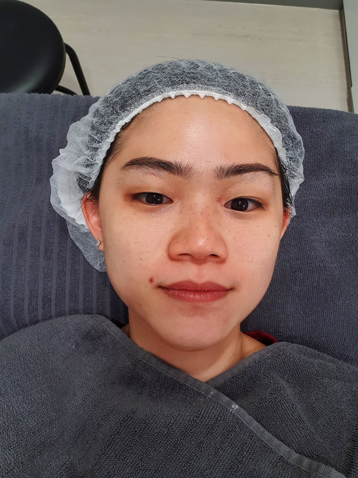 Treatment Review My First Lutronic Pico Laser With Sozo Looking At My Photo You Probably Know Why I Need To Do Pico Laser The Pigmentation Are Concentrated On Nose And Cheeks Areas Don T Agree That They