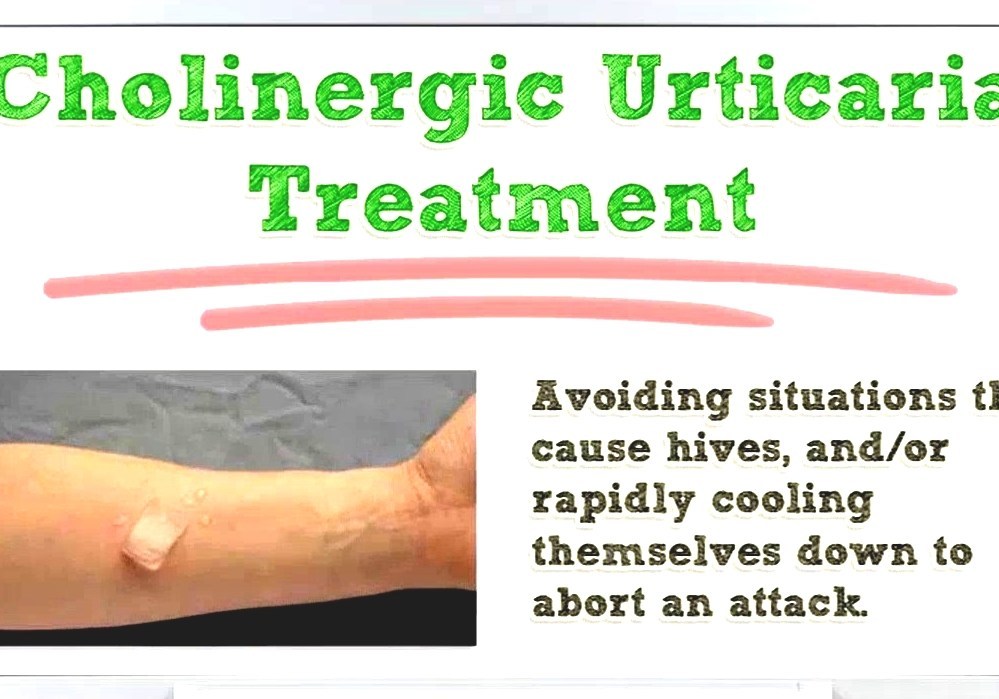 Cholinergic Urticaria Cholinergic Urticaria Cure