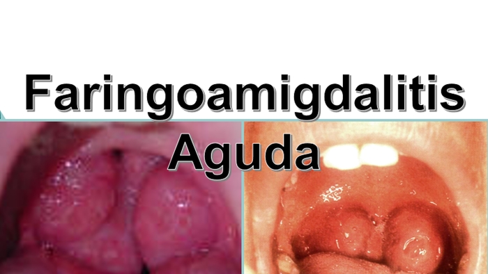 ORL - Faringoamigdalitis Aguda | USMP FN Archivos