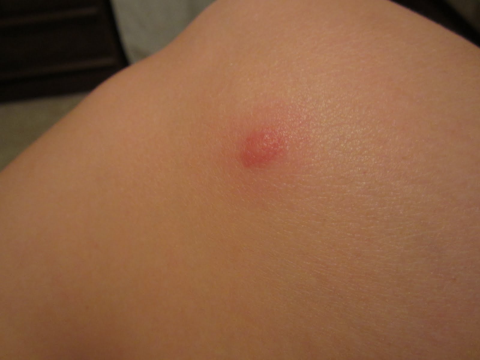 How do you treat insect bites that leave bruises ...