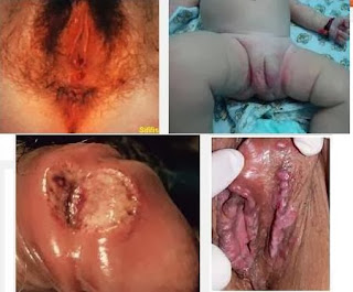 Obat Gatal-Gatal Pada Vagina Obat Gatal-Gatal Pada Vagina