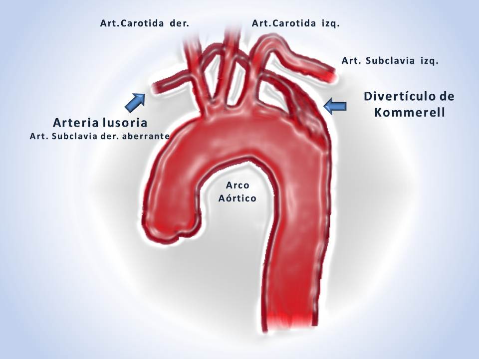 Правая аберрантная артерия. Артерия lusoria. Аберрантная правая подключичная артерия. Аберрантная правая подключичная артерия кт.