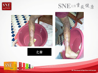 gambar testimoni psoriasis sembuh dengan seabuchthorn sbe sofgel gambar testimoni psoriasis sembuh dengan seabuchthorn sbe sofgel