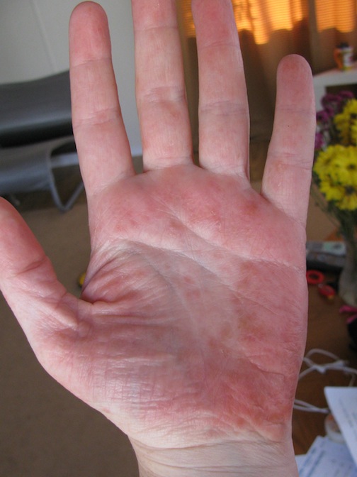 Small itchy bumps on hands? - Drugs.com