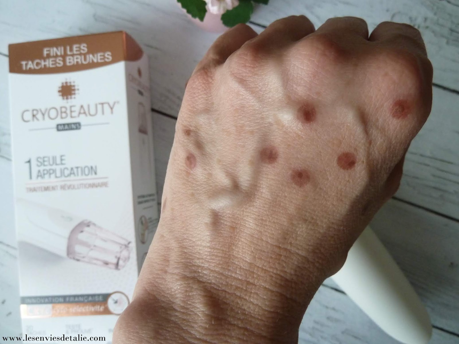 Taches Oranges Sur Les Mains Au Reveil Islam En finir avec les taches brunes avec Cryobeauty mains