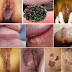 Testimoni Obat Penyakit Kutil Kelamin thumbnail