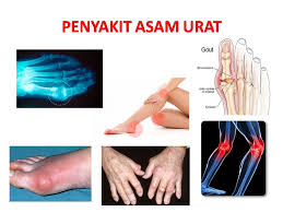 https://4.bp.blogspot.com/-7Pkwx5mNjAk/WMu1_SaZd6I/AAAAAAAACYo/Y3kf4NTtKfodL4FtUauw77sl8d4Ocy7tQCLcB/s1600/perbedaan-asam-urat-dan-rematik.jpg