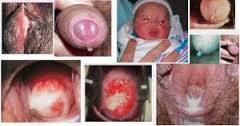 Foto Obat Masalah Buang Air Kecil Slalu Kluar Cairan Putih dan bau busuk