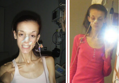Welcome to Olamama's blog!!!: The story of an anorexic woman who did ...