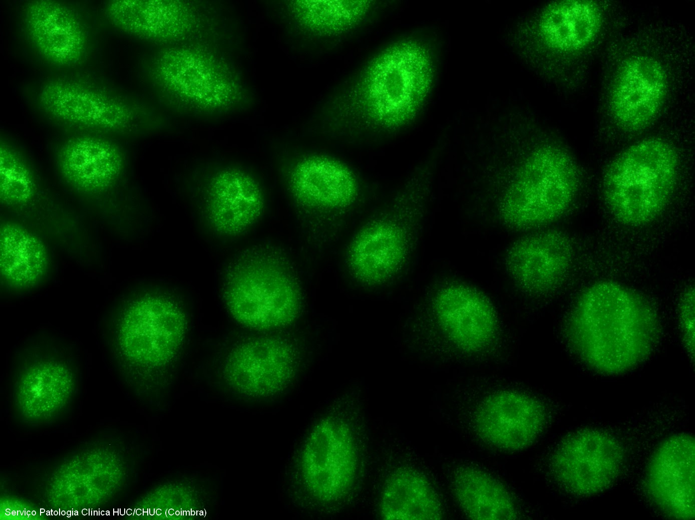 Anticorpos anti SSA (Ro) e anti
