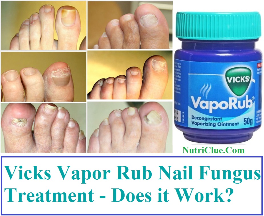 Vicks Damp Rub Cure Toenail Svampe
