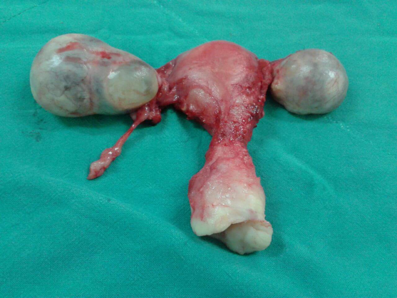 Con salpingooforectomia bilateral total abdominal histerectomia