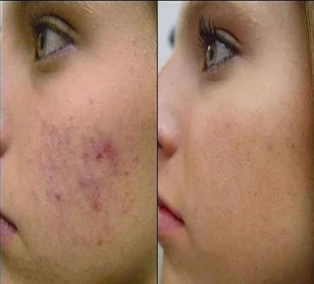 How To Clear Dark Spots On The Face Naturally How To Clear Dark Spots On The Face Naturally