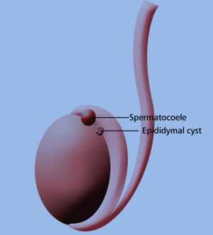 epididymitis a real pain essay Multiple sclerosis is a condition that affects your central nervous system in ms, the coating that protects your nerves (myelin) is damaged, causing a range of symptoms. epididymitis a real pain essay Multiple sclerosis is a condition that affects your central nervous system in ms, the coating that protects your nerves (myelin) is damaged, causing a range of symptoms.