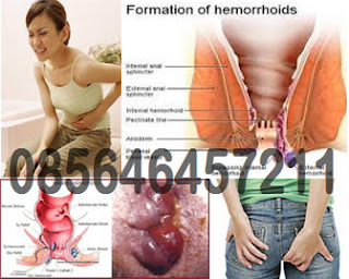Obat dan Ciri-Ciri Penyakit Wasir Hemoroid