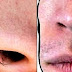 Jangan Cabut Bulu Hidung, Nanti Bisul Loh!