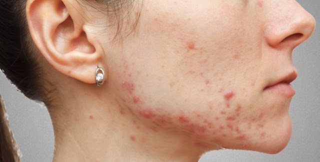 Home-Solutions-for-Acne-pimples-skin