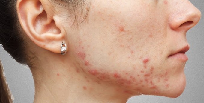 Home Solutions for Acne pimples skin
