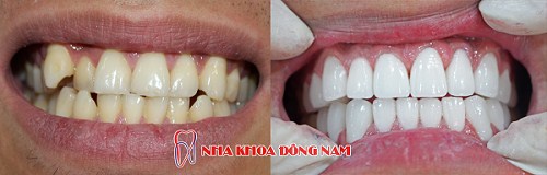 BỌC RĂNG SỨ CÓ HOÀN TẤT TRONG MỘT NGÀY KHÔNG -5