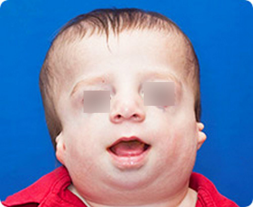 Treacher Collins Syndrome Pictures Medical Pictures and Images