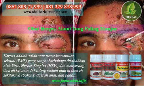 cara menyembuhkan penyakit herpes