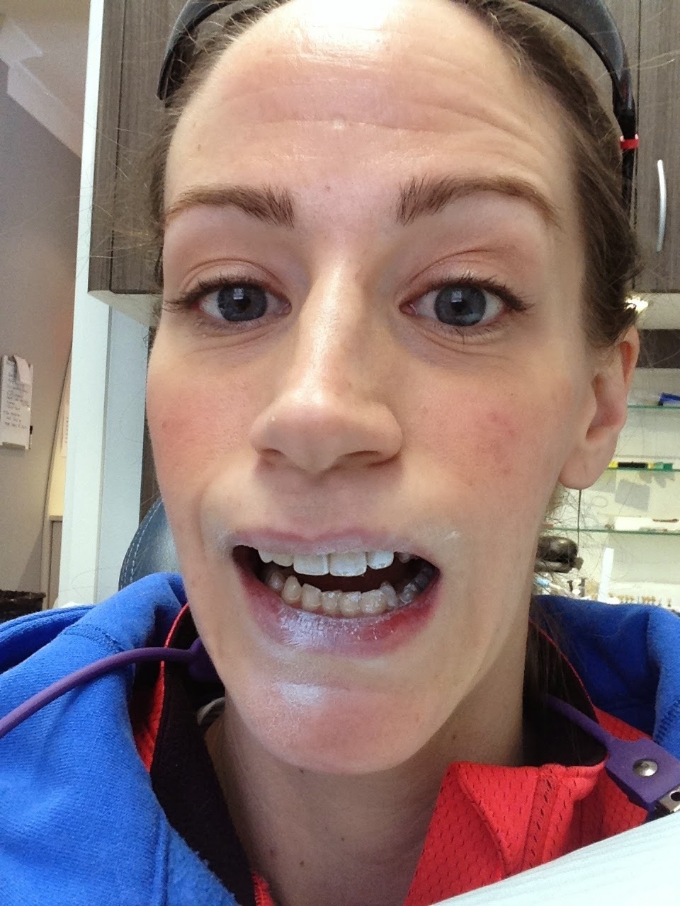 My Broken Jaw Trauma November 2014