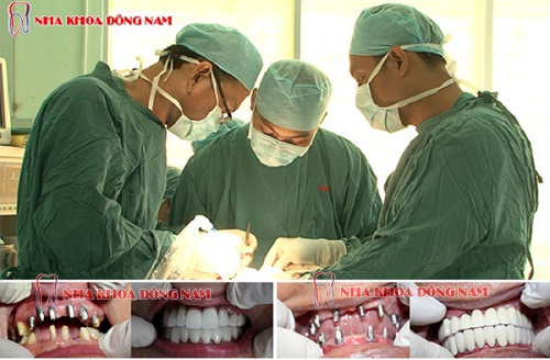 CẤY IMPLANT CHO BỆNH NHÂN CAO HUYẾT ÁP