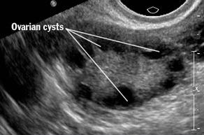 the fitter Fitter: the Dreaded "String of Pearls" - Life with PCOS