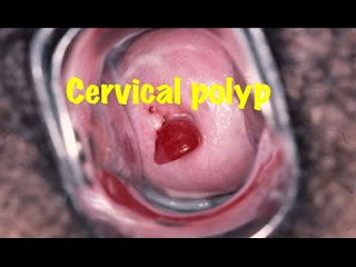 Polip Mulut Rahim (serviks) Polip Mulut Rahim (serviks)