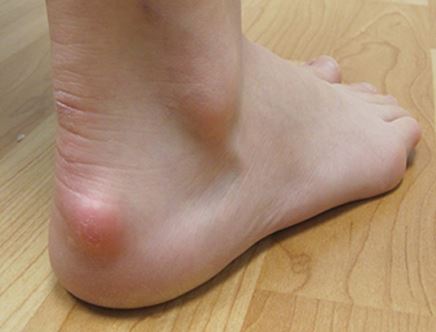 Trail Effect The Curse Of Pointy Heels Modifying Shoes For Haglund S Deformity