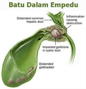 Pengobatan Batu Empedu Tanpa Operasi Laparoskopi Andalan Pengobatan Batu Empedu Tanpa Operasi Laparoskopi Andalan
