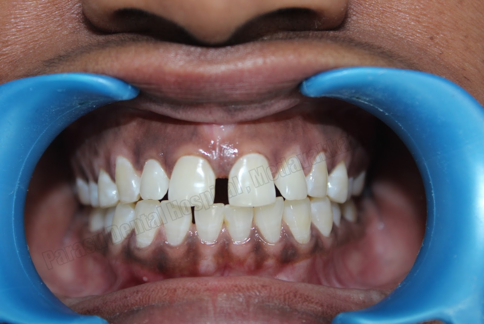 all on 4 implants in chennai midline diastema closure with composite