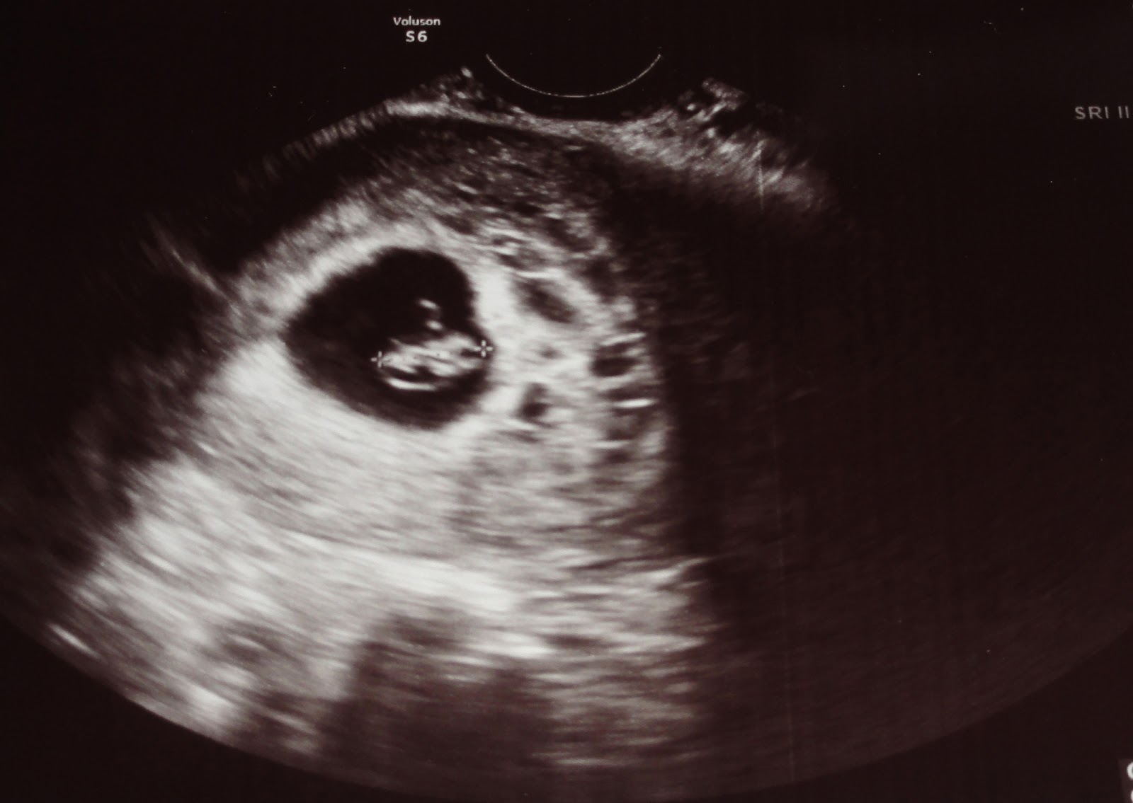 no heartbeat at 7 weeks successful pregnancy