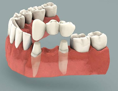 Gãy răng hàm dưới khắc phục thế nào?
