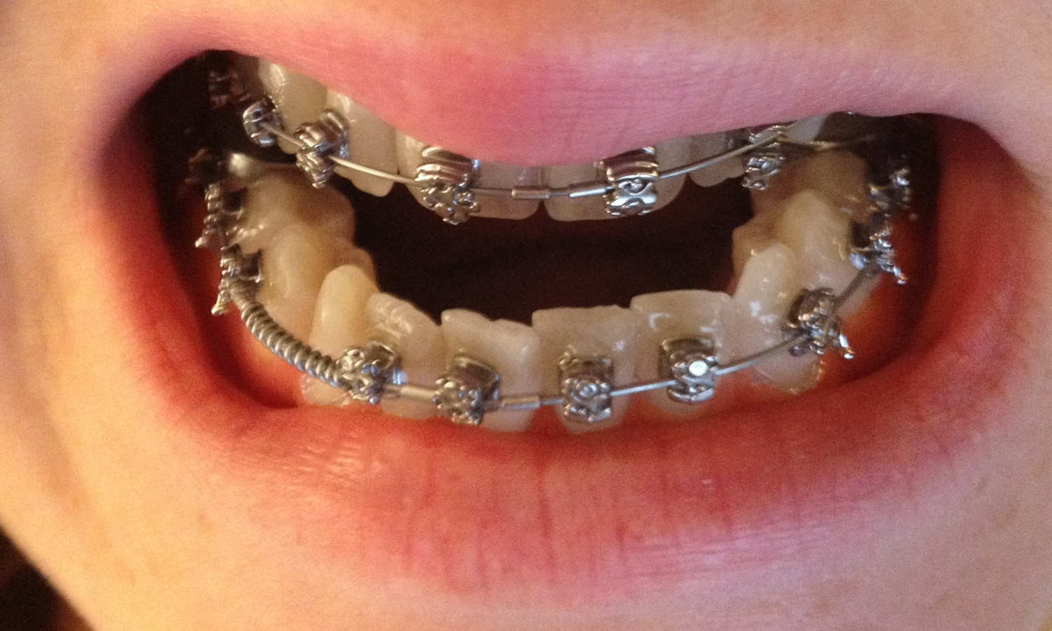 The 80s called. . . About the braces (with grotesque pics)