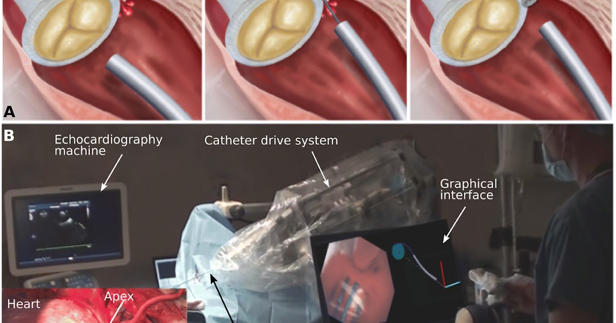 New Harvard catheter robot with haptic vision