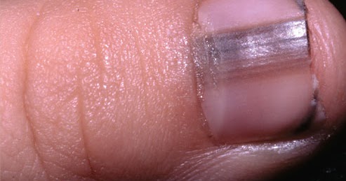 Dry fingernails treatment - Awesome Nail