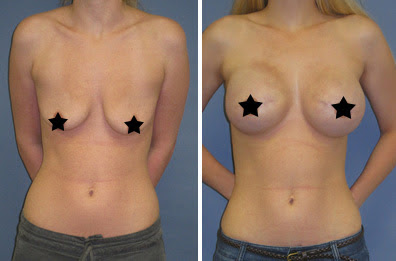 Antes e Depois Mamoplastia de Aumento Antes e Depois Mamoplastia de Aumento