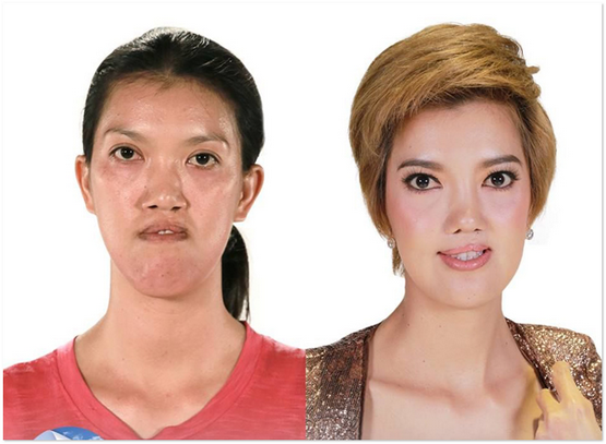17 Foto Menakjubkan Wanita Thai Sebelum Dan Selepas Pembedahan Plastik 17 Foto Menakjubkan Wanita Thai Sebelum Dan Selepas Pembedahan Plastik