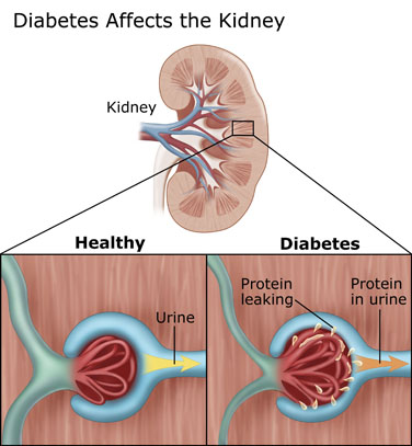 Diabetic, Senior and Black: Diabetic Nephropathy - Kidney Disease